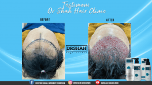 hair transplant