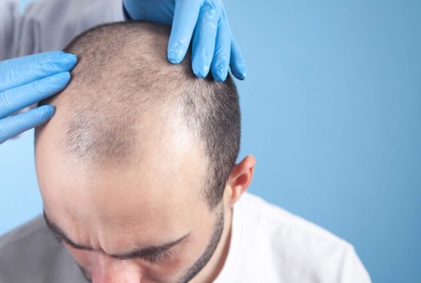 hair transplant