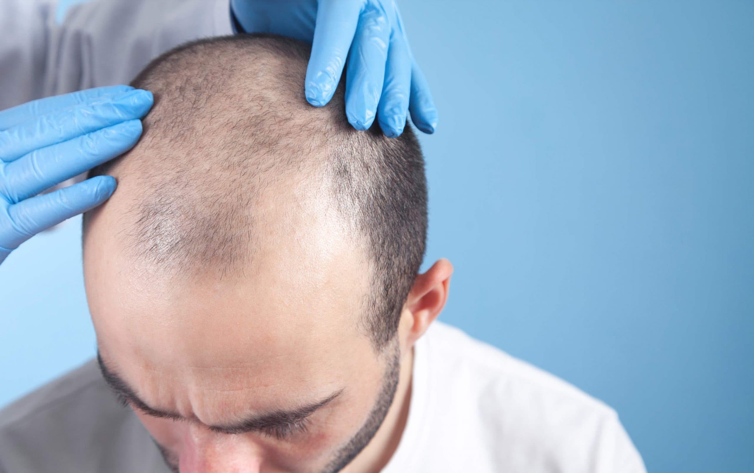 Adakah Hair Transplant Solusi Terbaik Untuk Anda?